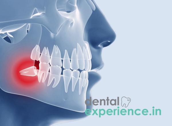 Impacted Wisdom Tooth